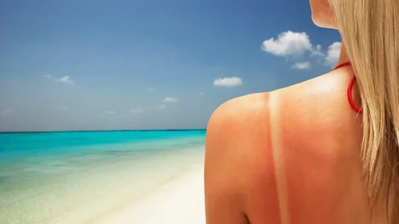 Kujdesi dermatologjik në verë: Si të mbrojmë lëkurën nga dëmtimet e diellit?