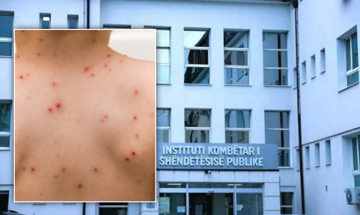 17 raste me fruth në Prishtinë, thirrje për vaksinim të fëmijëve